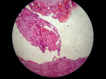 甲状腺肿物图3