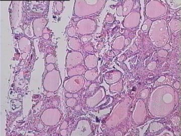 甲状腺囊肿标本，怀疑有问题，请老师帮忙。图1