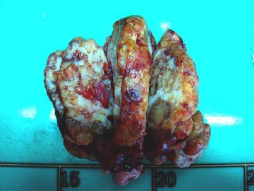 左卵巢肿瘤-普通切片图1
