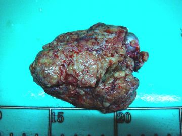 左卵巢肿瘤-普通切片图2