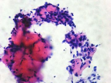 左卵巢肿瘤-普通切片图8