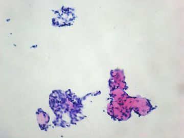 左卵巢肿瘤-普通切片图9