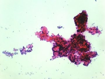 左卵巢肿瘤-普通切片图11