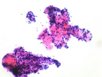 左卵巢肿瘤-普通切片图14