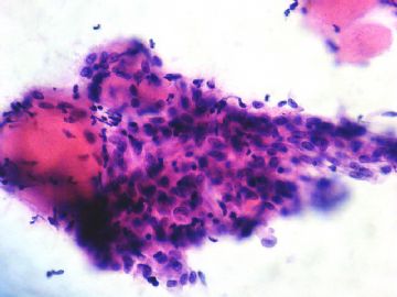 左卵巢肿瘤-普通切片图15