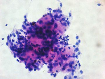左卵巢肿瘤-普通切片图16