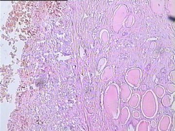 甲状腺肿物，可见鳞状上皮，是鳞化？还是别的？图3