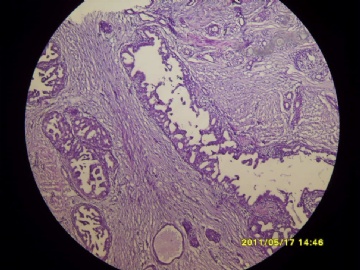 乳晕下约1CM肿物2年，花生米大。图2