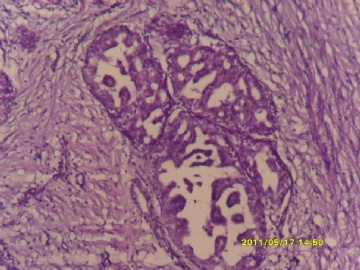 乳晕下约1CM肿物2年，花生米大。图7