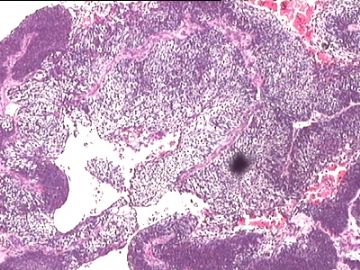 宫颈赘生物：低分化鳞癌？还是腺鳞癌？这种活检标本我们要报浸润深度吗？图10