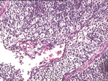 宫颈赘生物：低分化鳞癌？还是腺鳞癌？这种活检标本我们要报浸润深度吗？图11