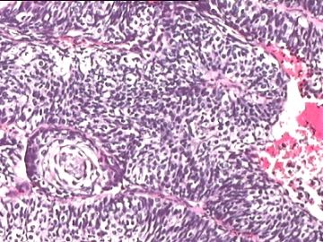 宫颈赘生物：低分化鳞癌？还是腺鳞癌？这种活检标本我们要报浸润深度吗？图12