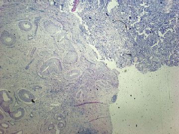 左卵巢肿瘤-普通切片图34