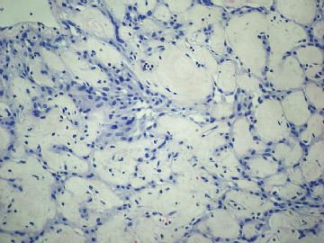 左卵巢肿瘤-普通切片图41