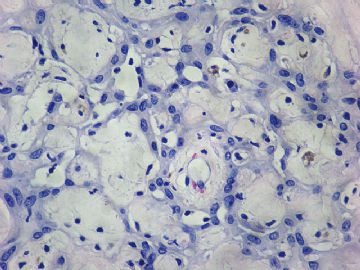左卵巢肿瘤-普通切片图43