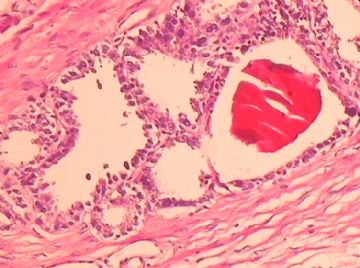 请教各位老师，这个前列腺是不是癌？还是前列腺后尿道的腺体？图11