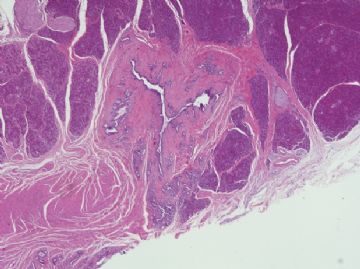 胰腺病例-地坛图1