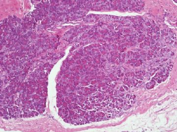 胰腺病例-地坛图10