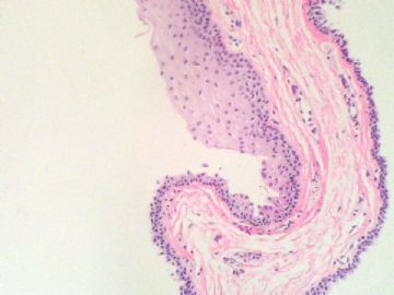 经典病例学习-阴茎中缝囊肿图9