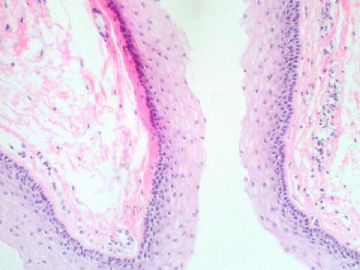 经典病例学习-阴茎中缝囊肿图10