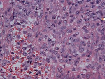 1408-20110605皮肤T细胞淋巴瘤非特指，高侵袭性图4