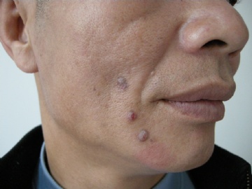 面部皮疹图1