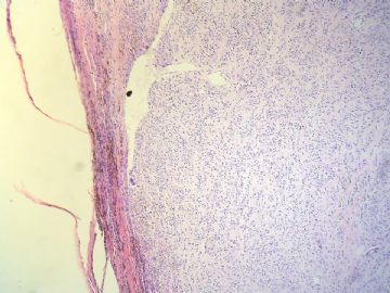 经典病例学习-腱鞘巨细胞瘤图1
