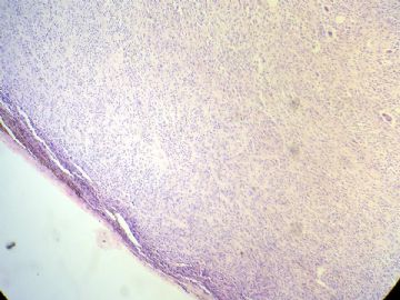 经典病例学习-腱鞘巨细胞瘤图2