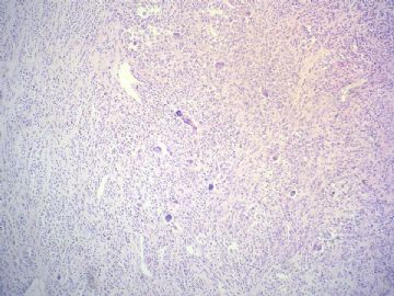 经典病例学习-腱鞘巨细胞瘤图3