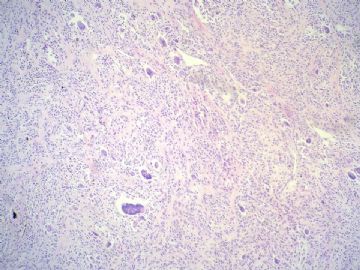 经典病例学习-腱鞘巨细胞瘤图4