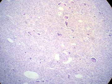 经典病例学习-腱鞘巨细胞瘤图5