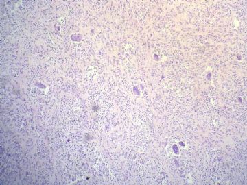 经典病例学习-腱鞘巨细胞瘤图6