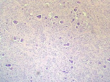 经典病例学习-腱鞘巨细胞瘤图7