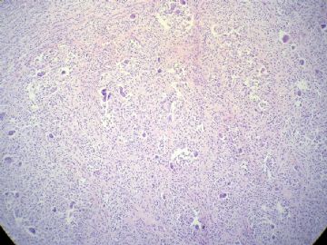 经典病例学习-腱鞘巨细胞瘤图8