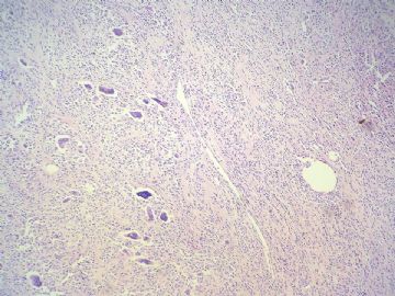经典病例学习-腱鞘巨细胞瘤图9