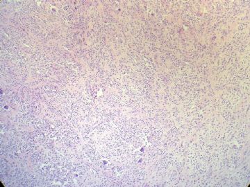 经典病例学习-腱鞘巨细胞瘤图10