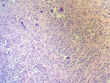 经典病例学习-腱鞘巨细胞瘤图11