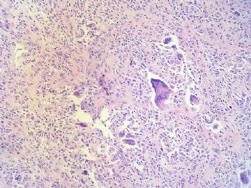 经典病例学习-腱鞘巨细胞瘤图12