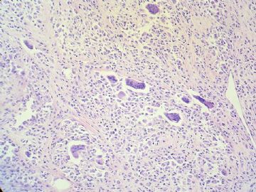 经典病例学习-腱鞘巨细胞瘤图13