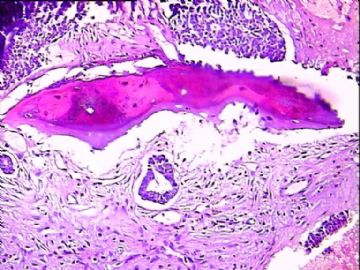 骨肿瘤？图10
