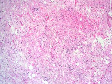 经典病例学习-肾血管平滑肌脂肪瘤图4