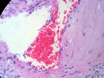 经典病例学习-肾血管平滑肌脂肪瘤图13