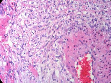 经典病例学习-肾血管平滑肌脂肪瘤图14
