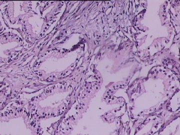 前列腺电切,癌,癌前?图2