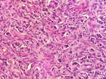 经典病例学习-卵巢krukenberg瘤图7