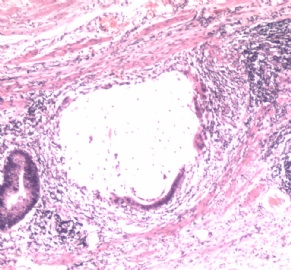 阑尾粘液囊腺瘤？粘液腺癌？图12