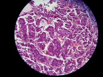 肠镜图2