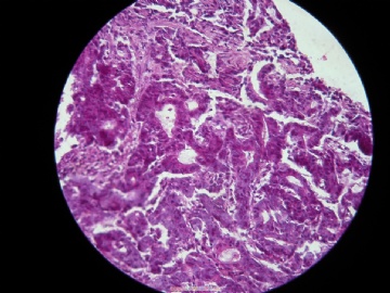 肠镜图6