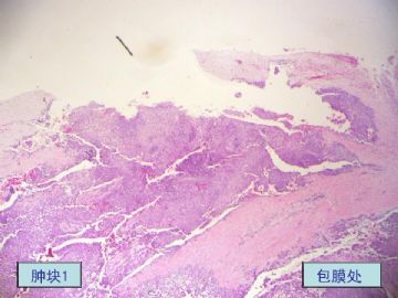 右颌下肿块，新加免疫组化-唾腺中鲜见的肿瘤类型图3