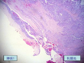 右颌下肿块，新加免疫组化-唾腺中鲜见的肿瘤类型图4